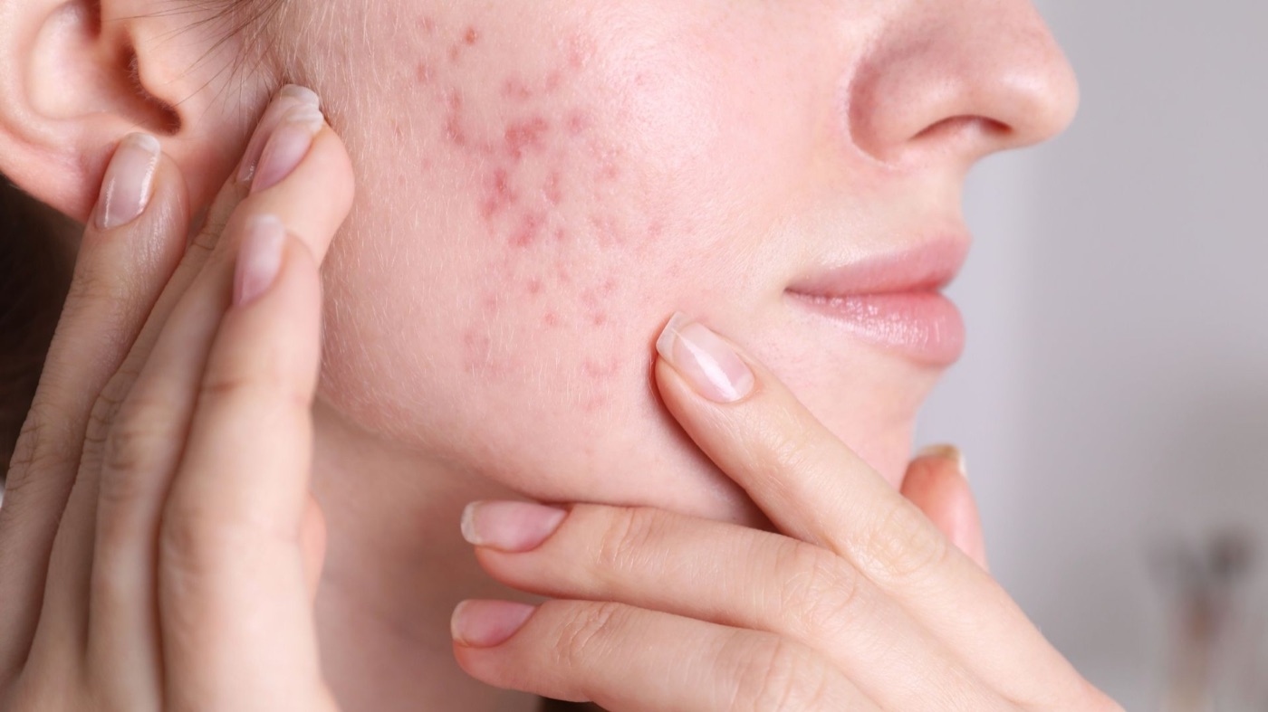 Acne Facial service in Alpharetta GA at Glow by NC