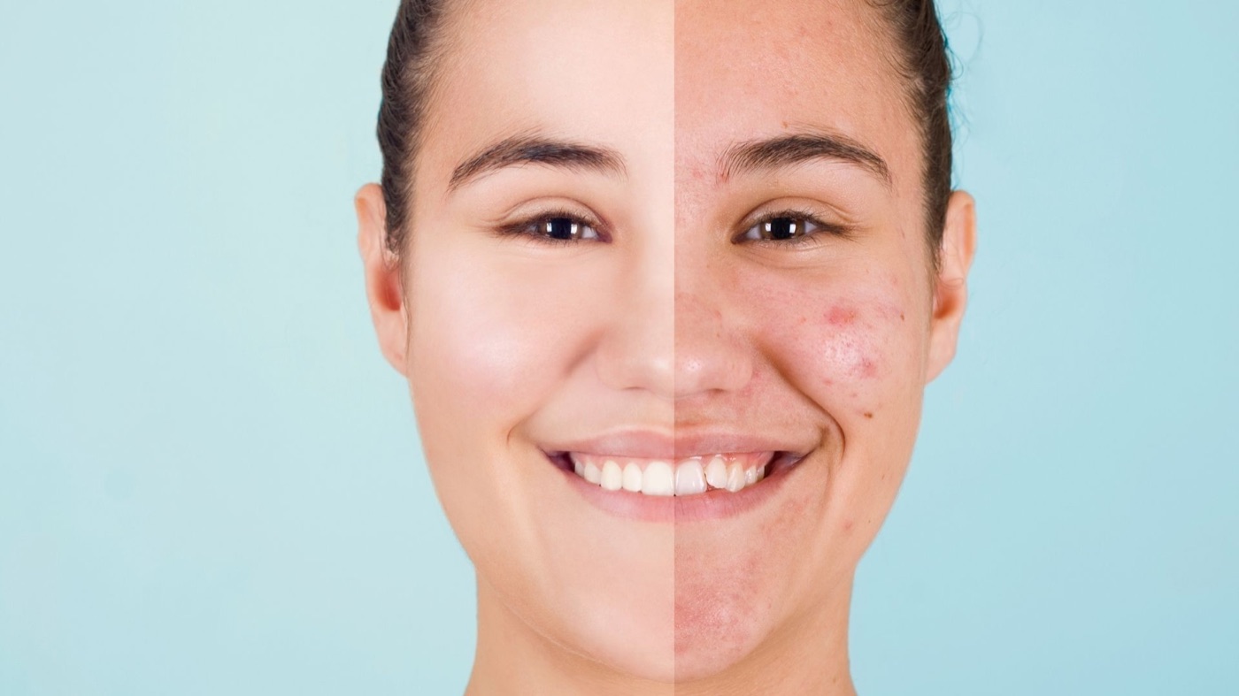 Glow by NC Acne Facial detail in Alpharetta GA