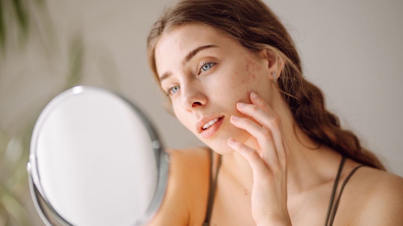 Acne Facial photo for Glow by NC in Alpharetta GA